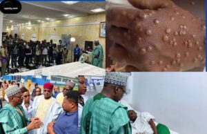 « Nous venons ici vous donner la bonne information, pour faire un point de la situation du Gouvernement sous l’égide du Président de la République, Son Excellence Monsieur Paul Biya, sur ce qui a déjà été fait dans le cadre de la lutte contre la riposte Mpox au Cameroun et ce que nous entrevoyons faire » : le Minsanté s’exprime à l&rsquo;hôpital Laquintinie.